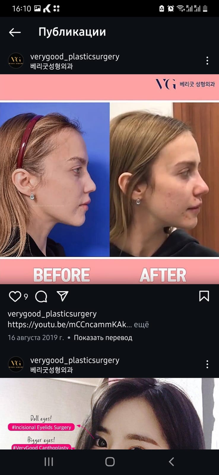 Before and after result by Dr. Im Young Min