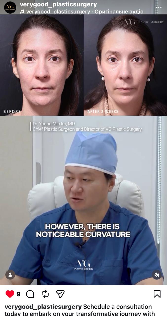 Before and after result by Dr. Im Young Min