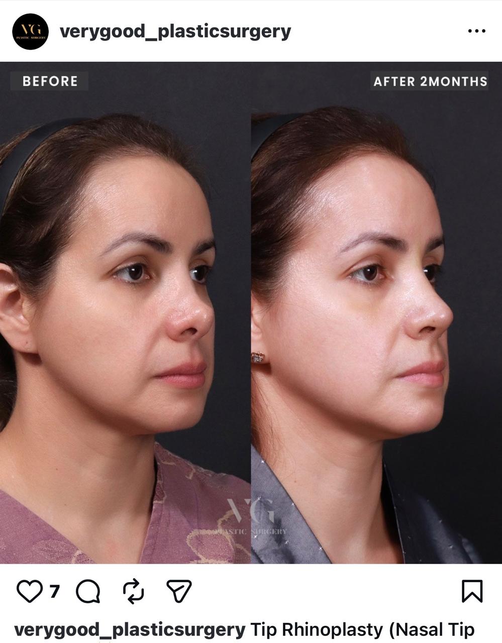 Before and after result by Dr. Im Young Min
