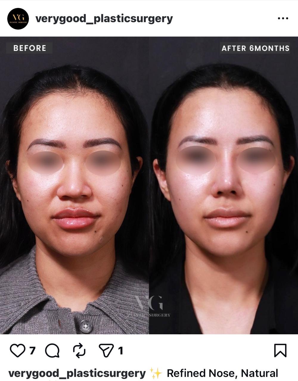 Before and after result by Dr. Im Young Min