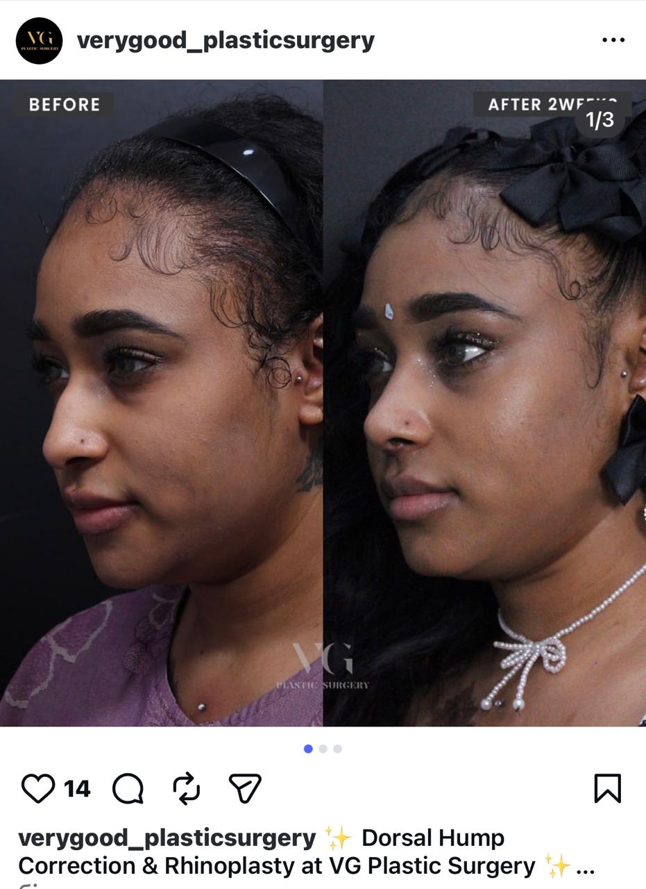 Before and after result by Dr. Im Young Min