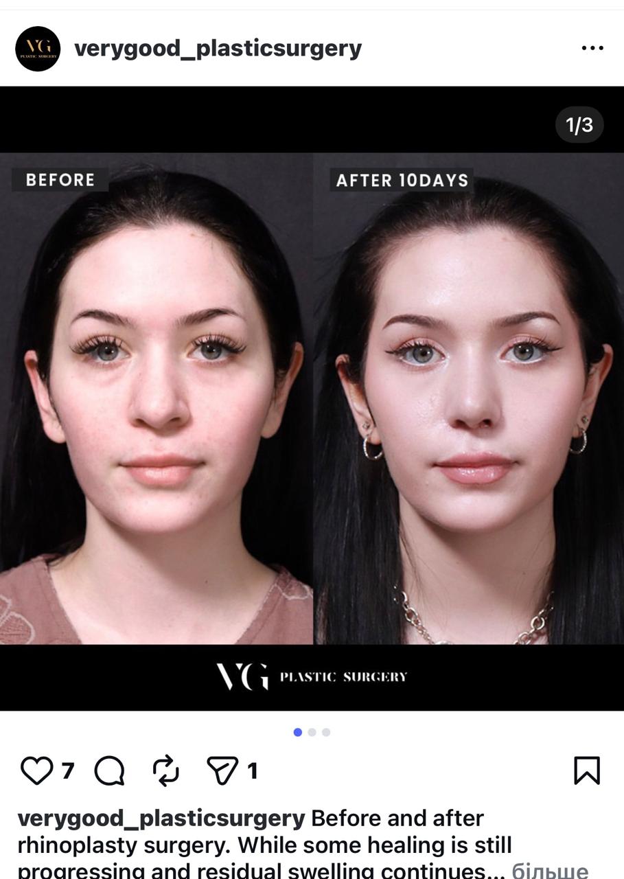 Before and after result by Dr. Im Young Min