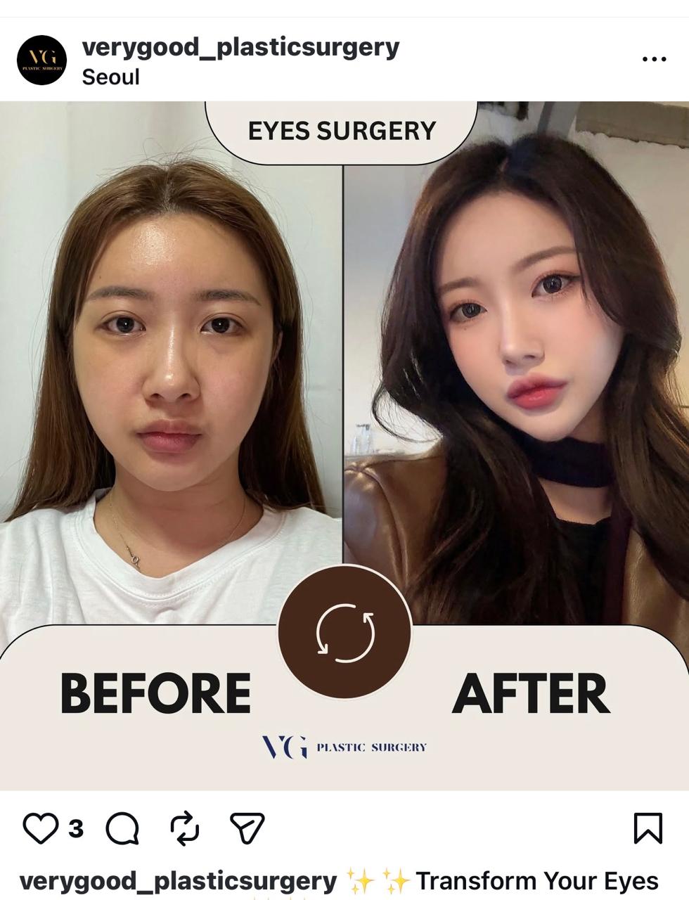 Before and after result by Dr. Im Young Min