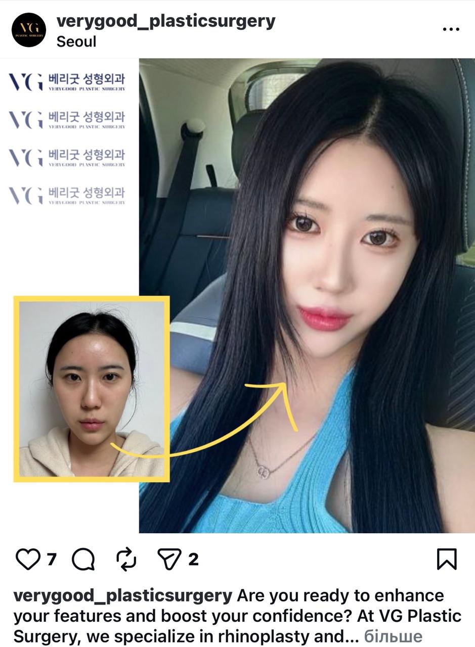 Before and after result by Dr. Im Young Min