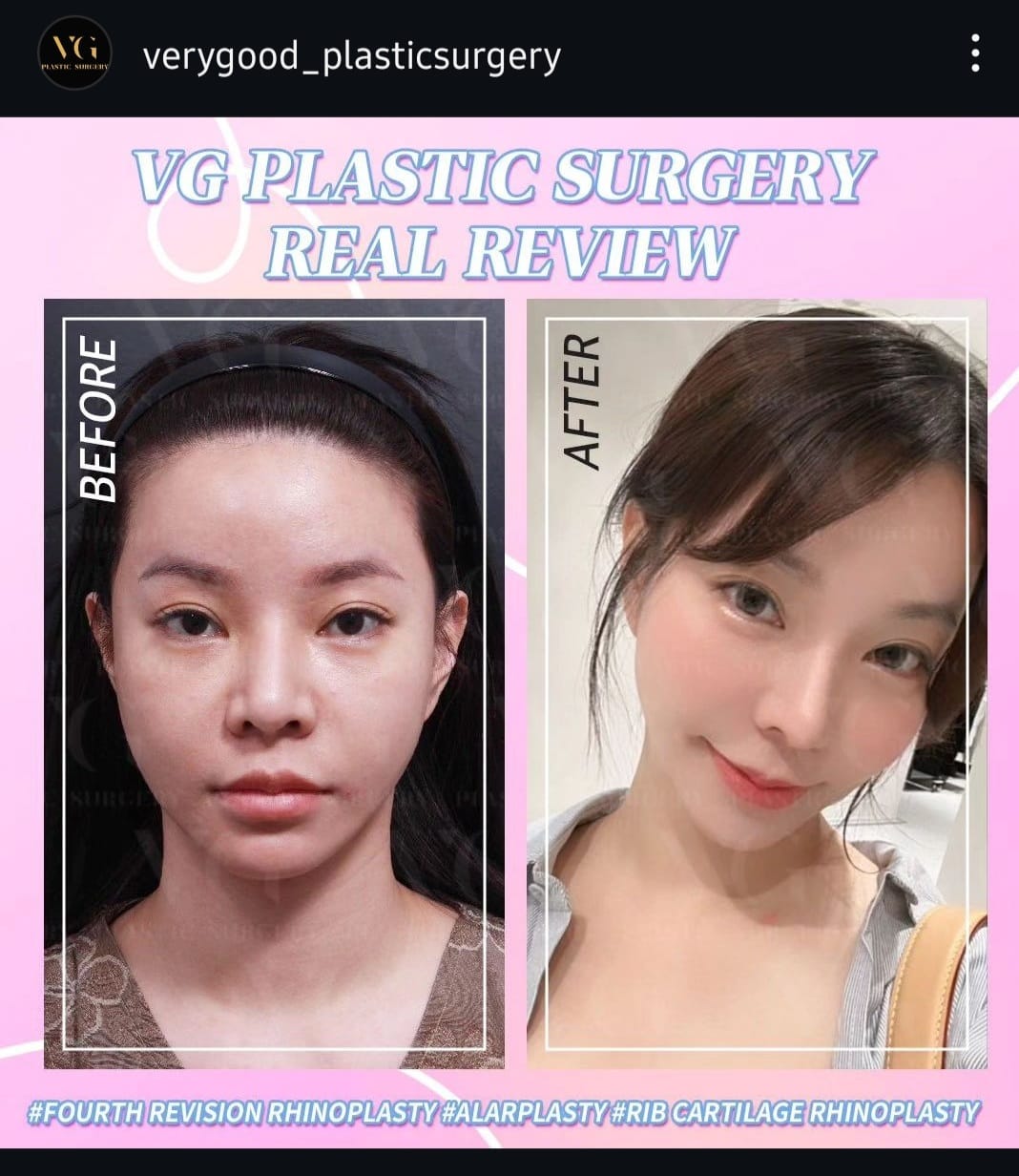 Before and after result by Dr. Im Young Min