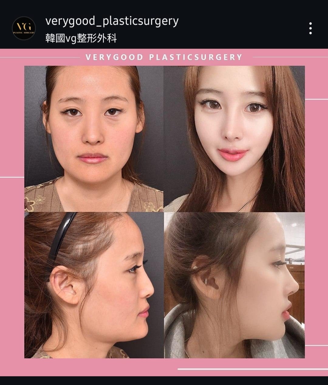 Before and after result by Dr. Im Young Min