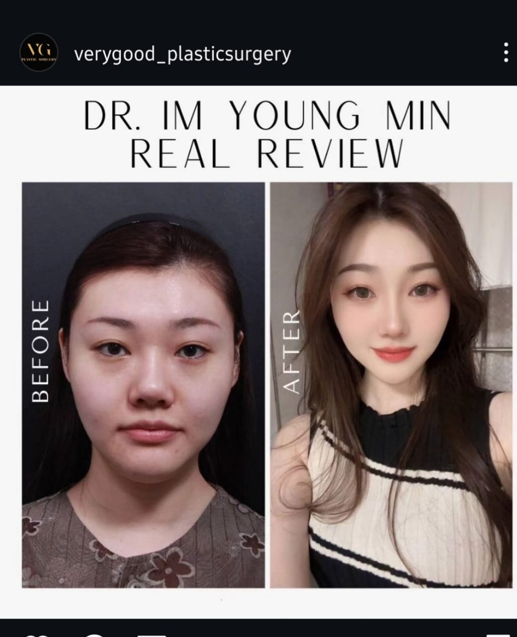 Before and after result by Dr. Im Young Min