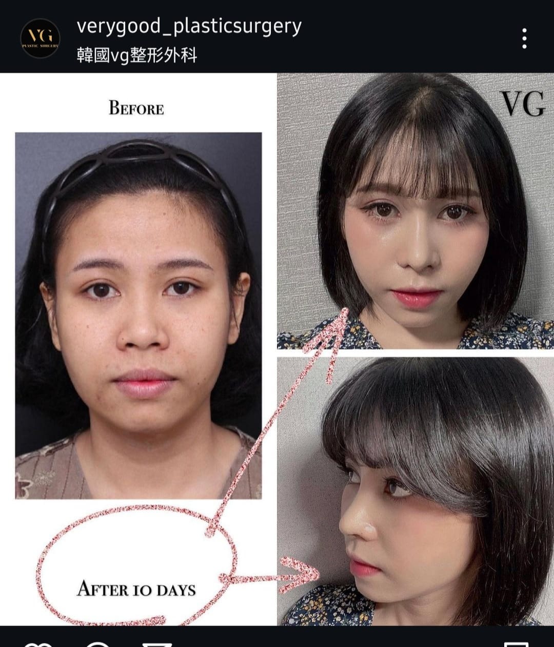 Before and after result by Dr. Im Young Min