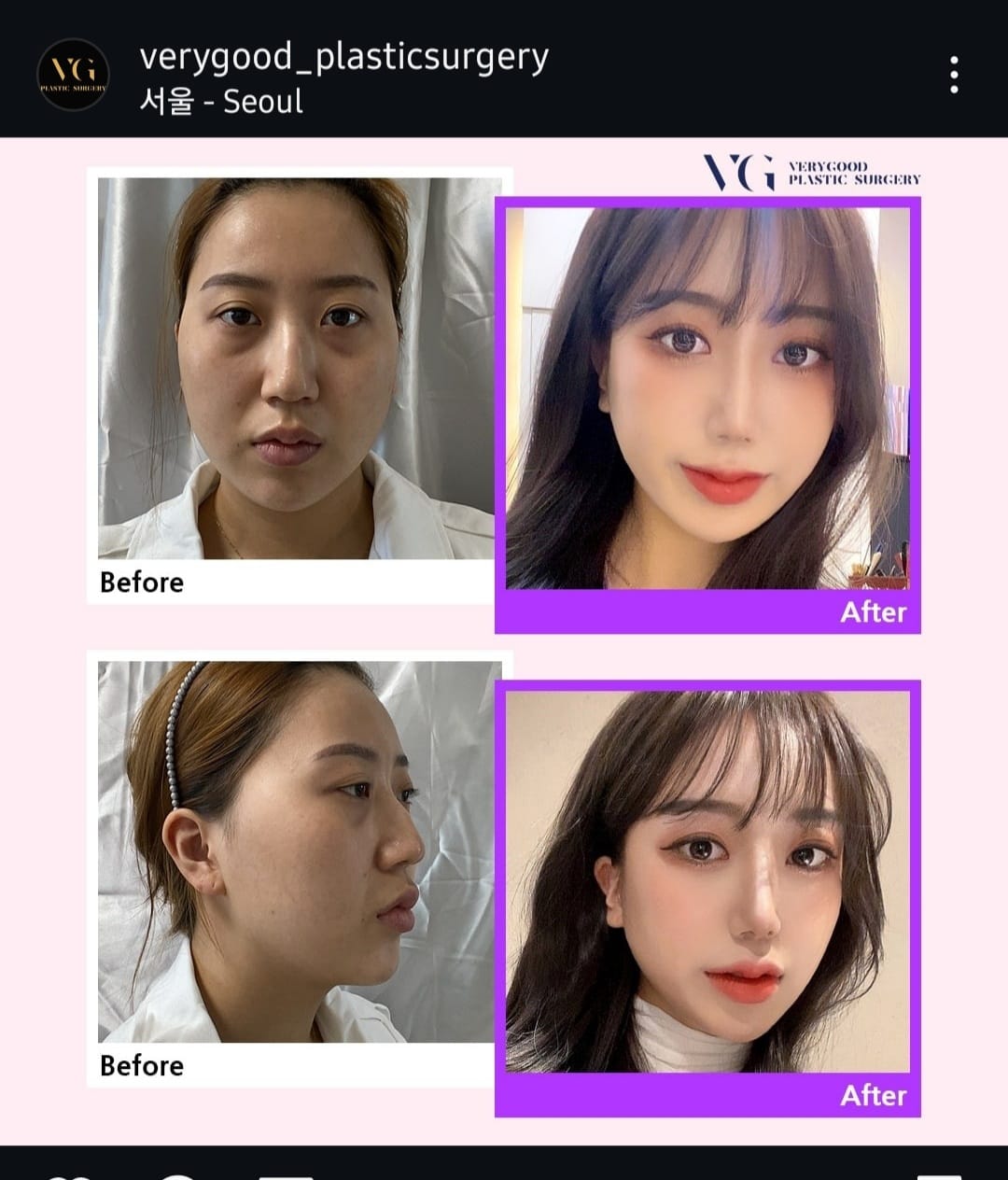 Before and after result by Dr. Im Young Min