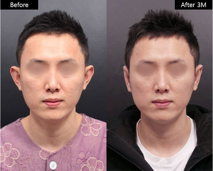 Before and after result by Dr. Im Young Min