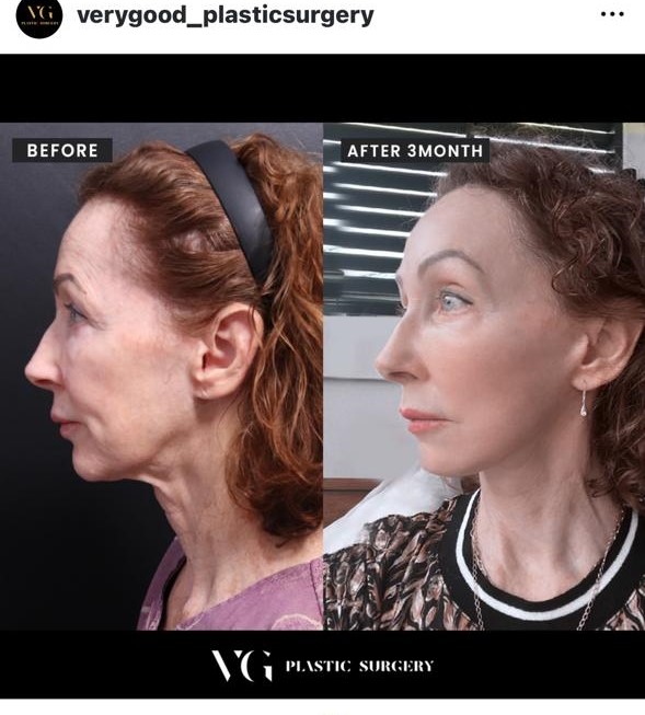 Before and after result by Dr. Kim Yong Woo