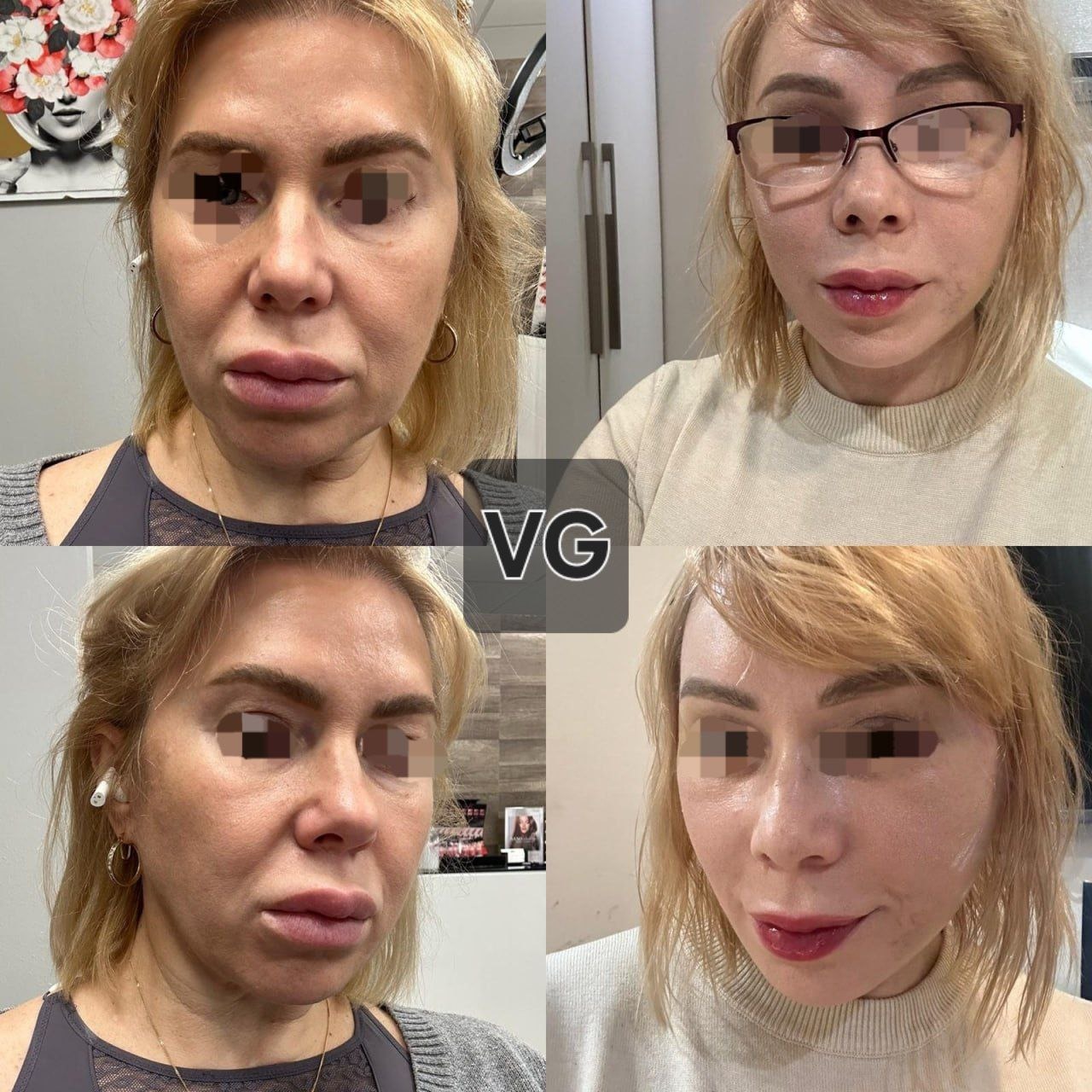 Before and after result by Dr. Kim Yong Woo