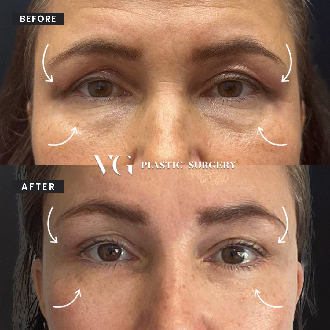 Before and after result by Dr. Kim Yong Woo