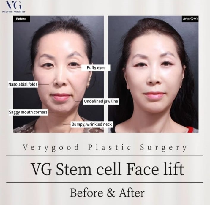 Before and after result by Dr. Kim Yong Woo