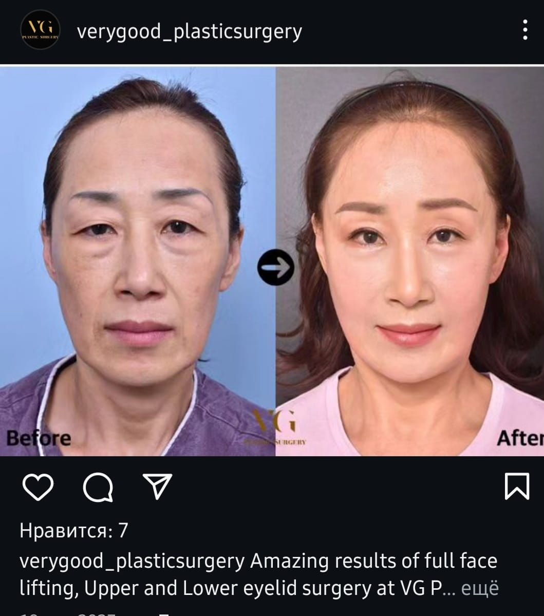 Before and after result by Dr. Kim Yong Woo