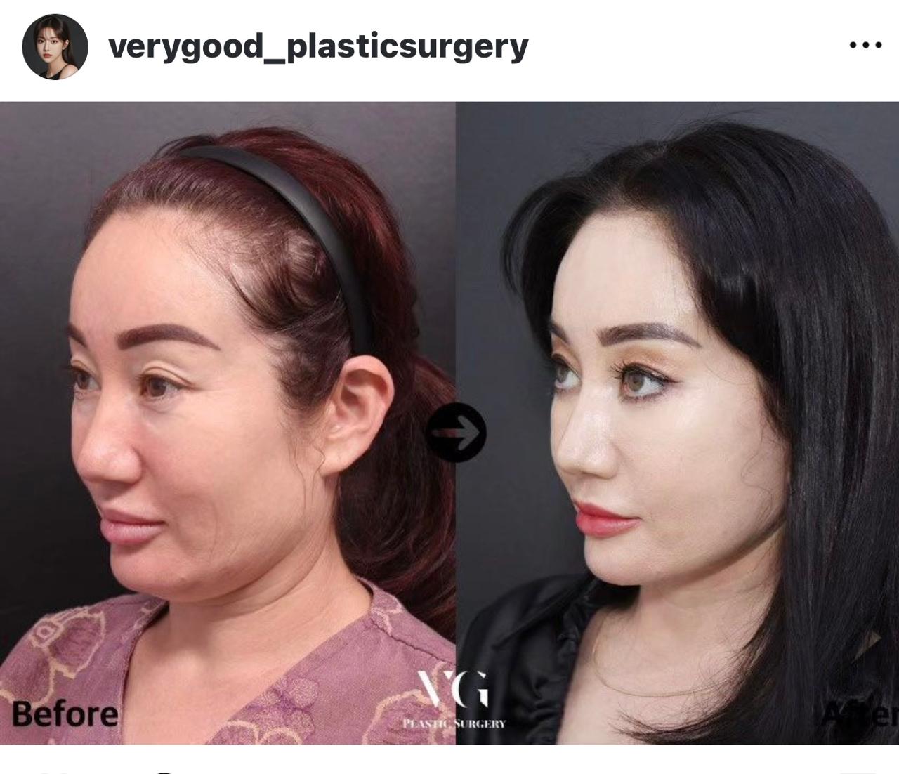 Before and after result by Dr. Kim Yong Woo