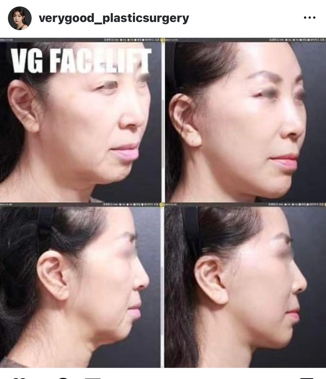 Before and after result by Dr. Kim Yong Woo