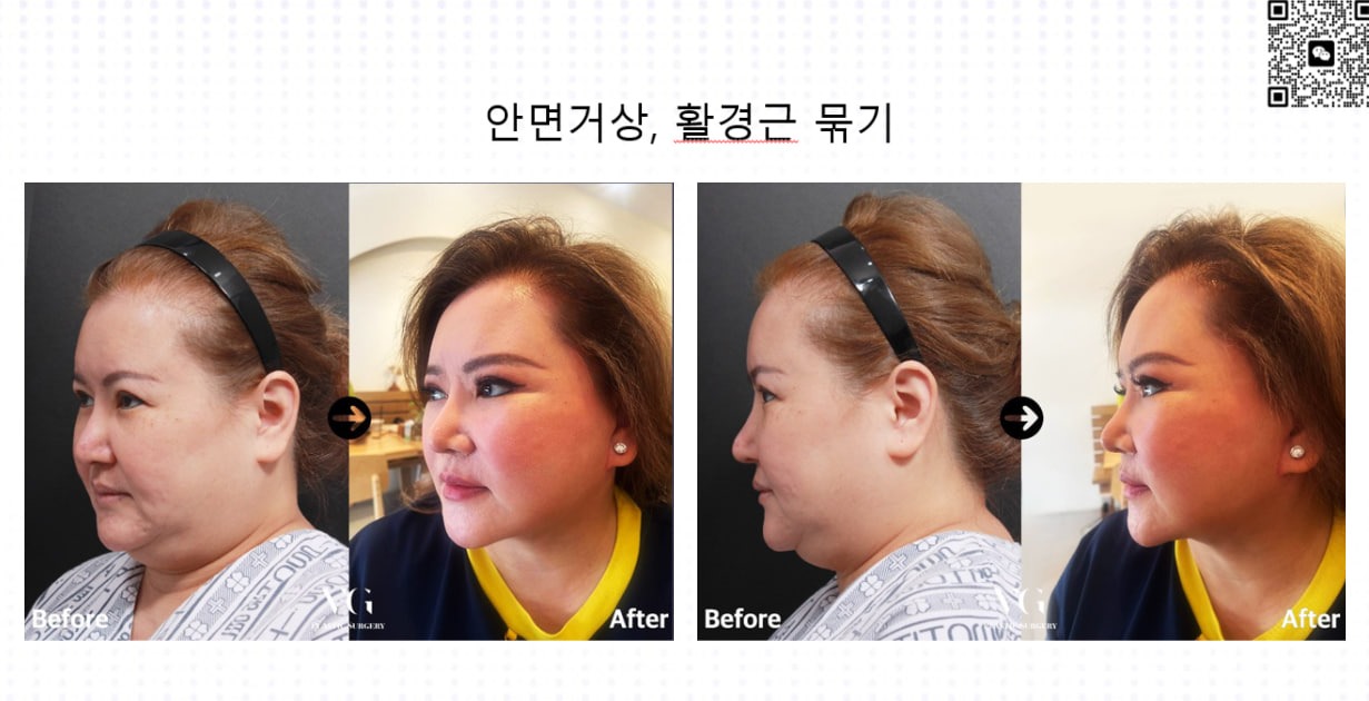 Before and after result by Dr. Kim Yong Woo