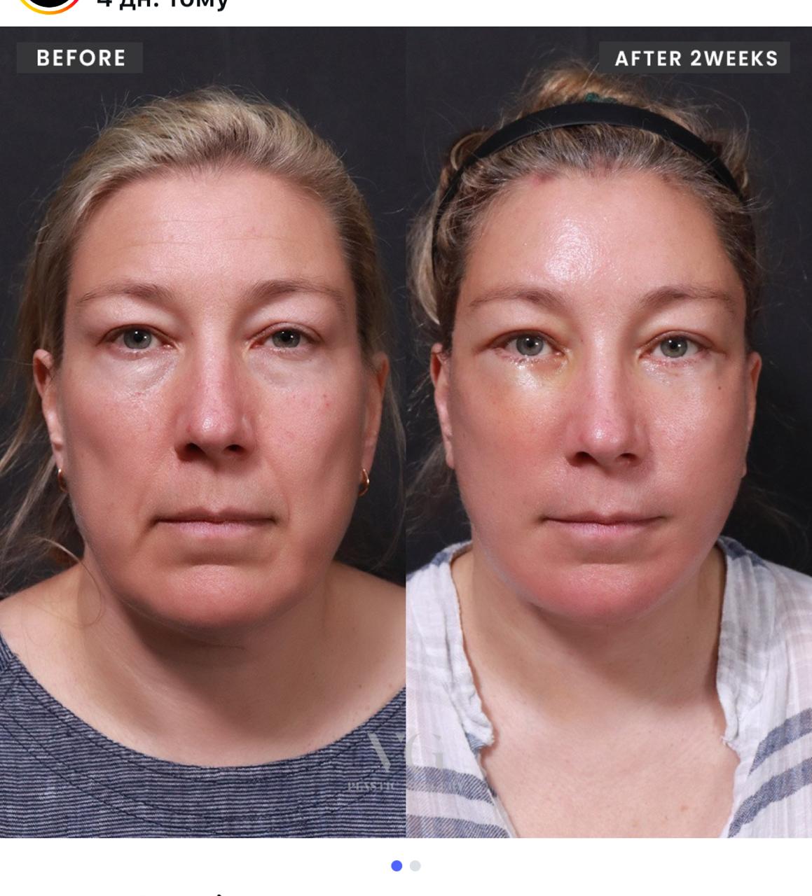 Before and after result by Dr. Kim Yong Woo