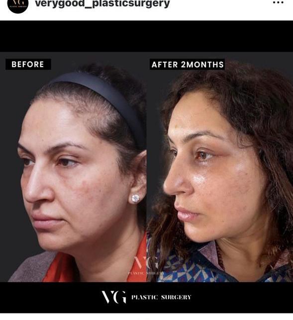 Before and after result by Dr. Kim Yong Woo