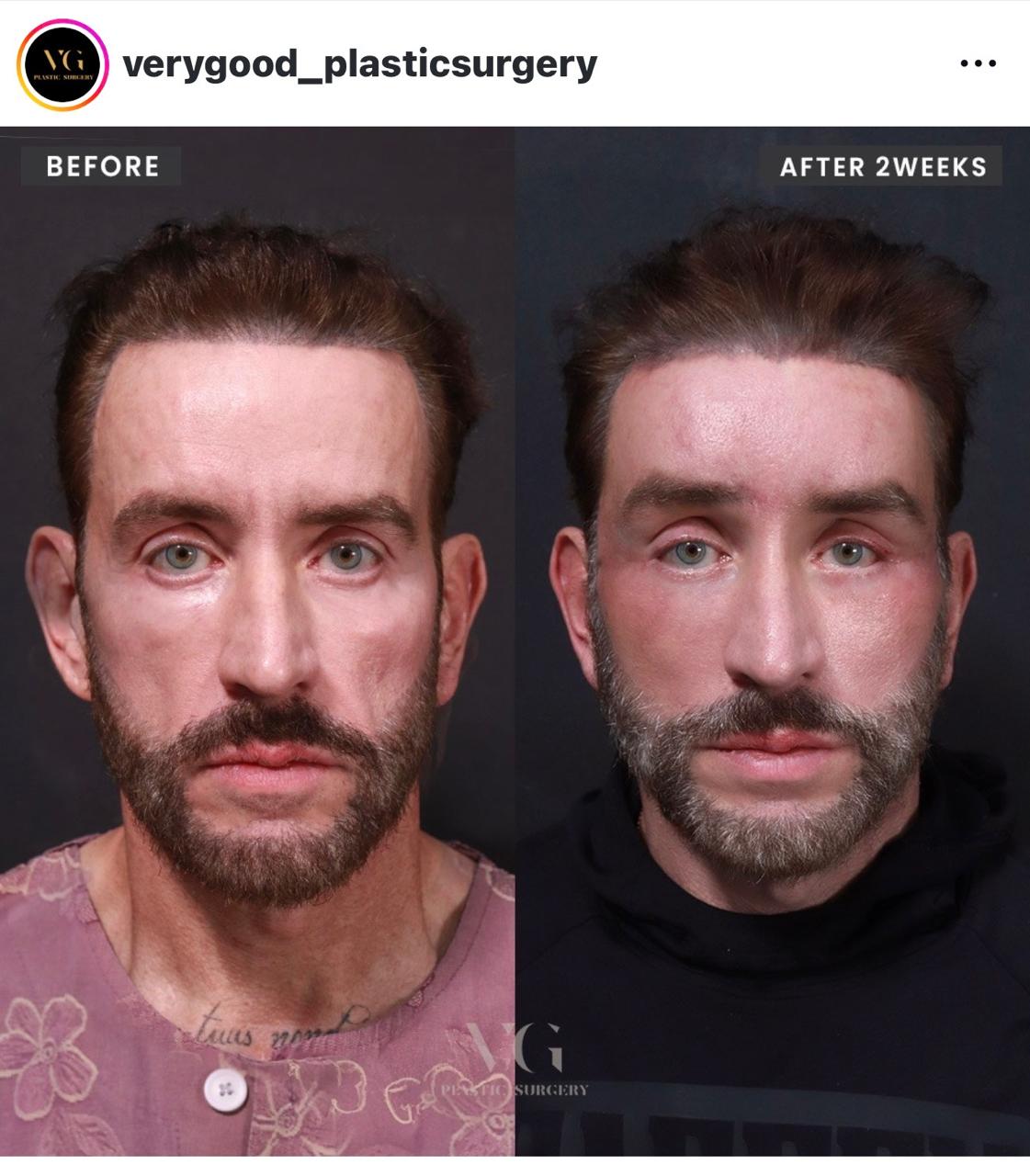 Before and after result by Dr. Kim Yong Woo