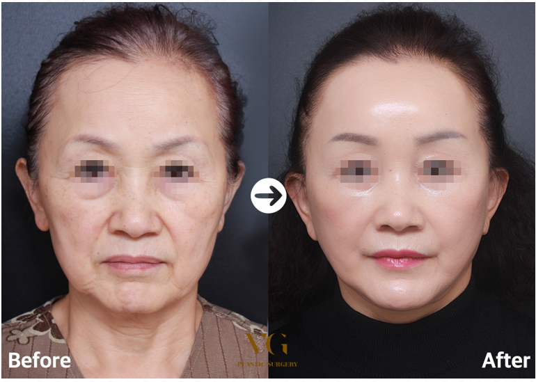 Before and after result by Dr. Kim Yong Woo