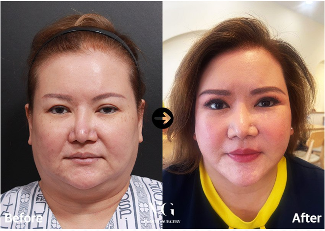 Before and after result by Dr. Kim Yong Woo
