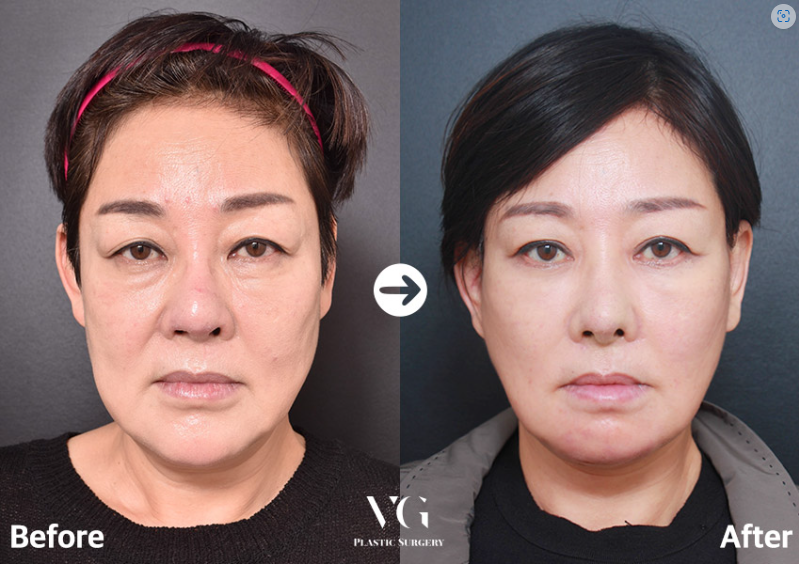 Before and after result by Dr. Kim Yong Woo
