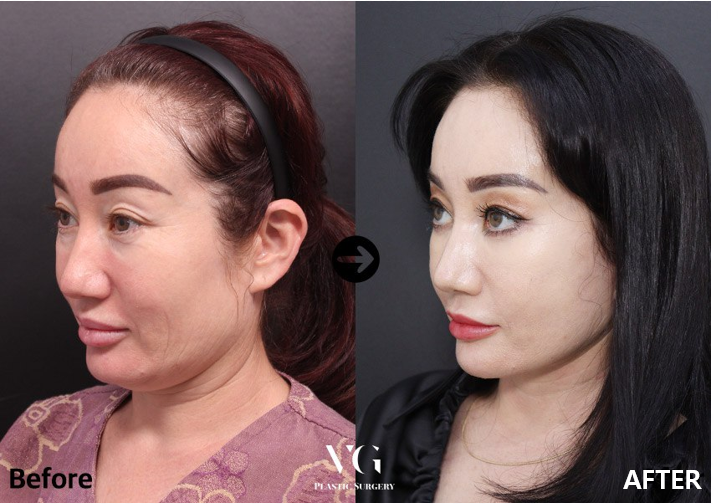 Before and after result by Dr. Kim Yong Woo
