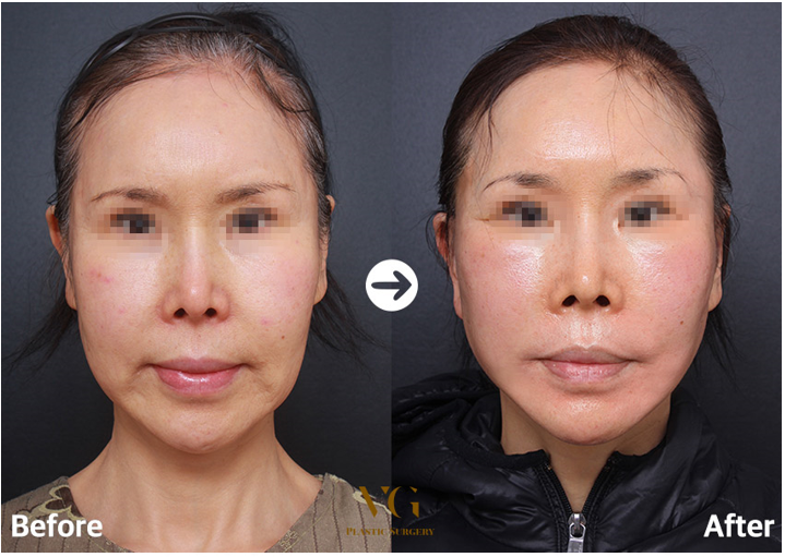 Before and after result by Dr. Kim Yong Woo