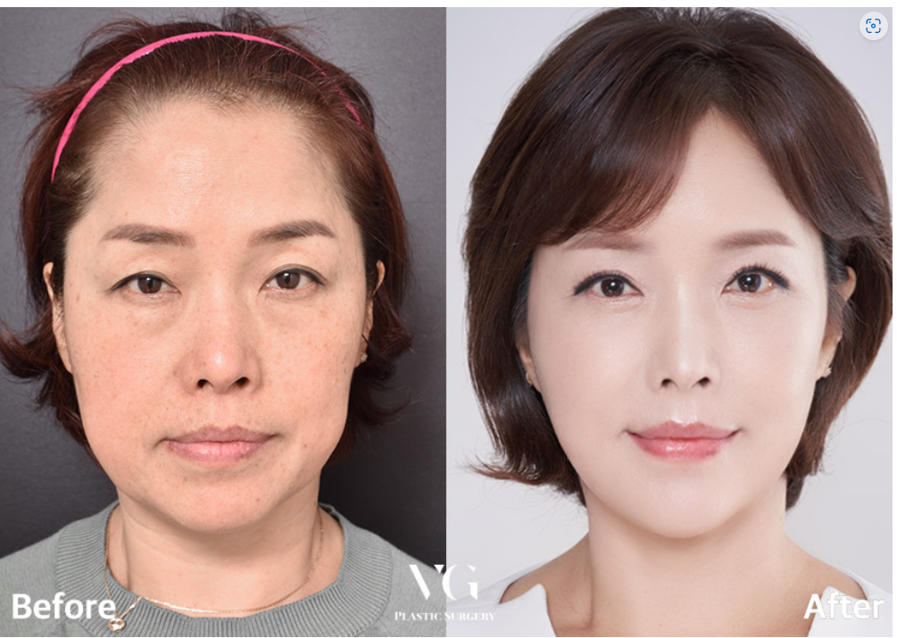 Before and after result by Dr. Kim Yong Woo