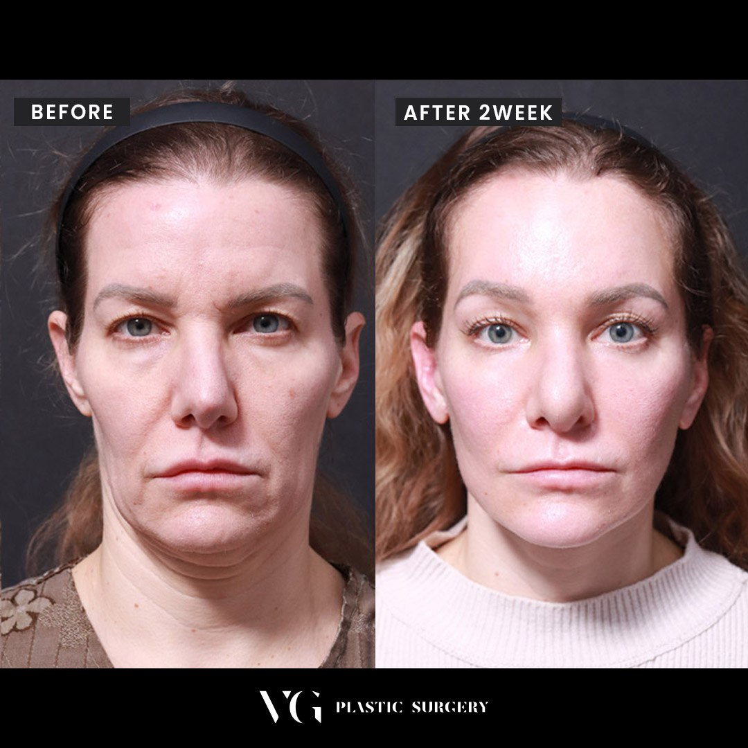 Before and after result by Dr. Kim Yong Woo