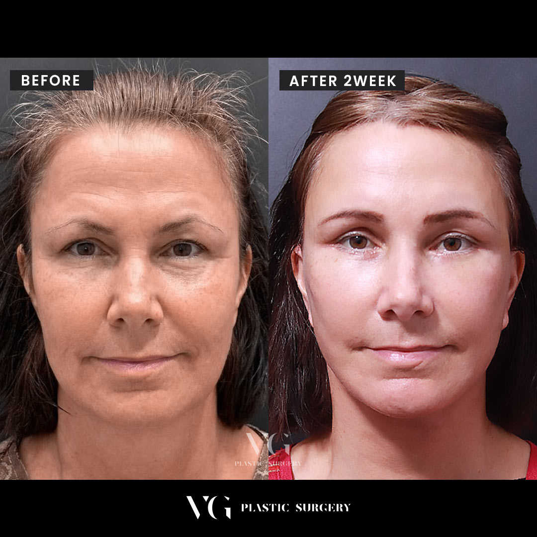 Before and after result by Dr. Kim Yong Woo