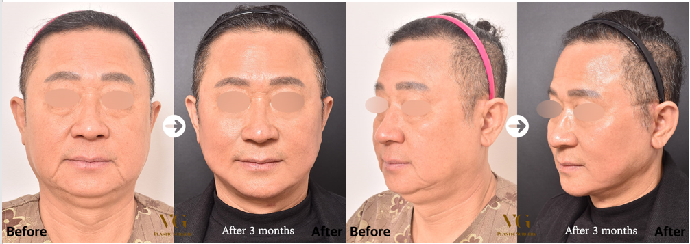 Before and after result by Dr. Kim Yong Woo