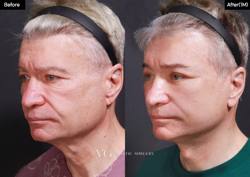 Before and after result by Dr. Kim Yong Woo