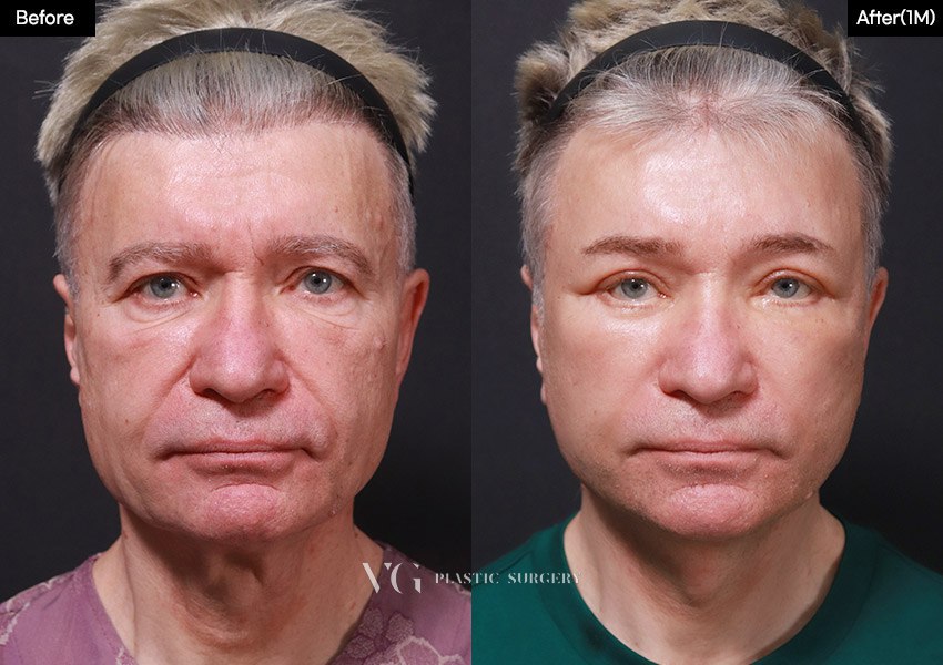 Before and after result by Dr. Kim Yong Woo