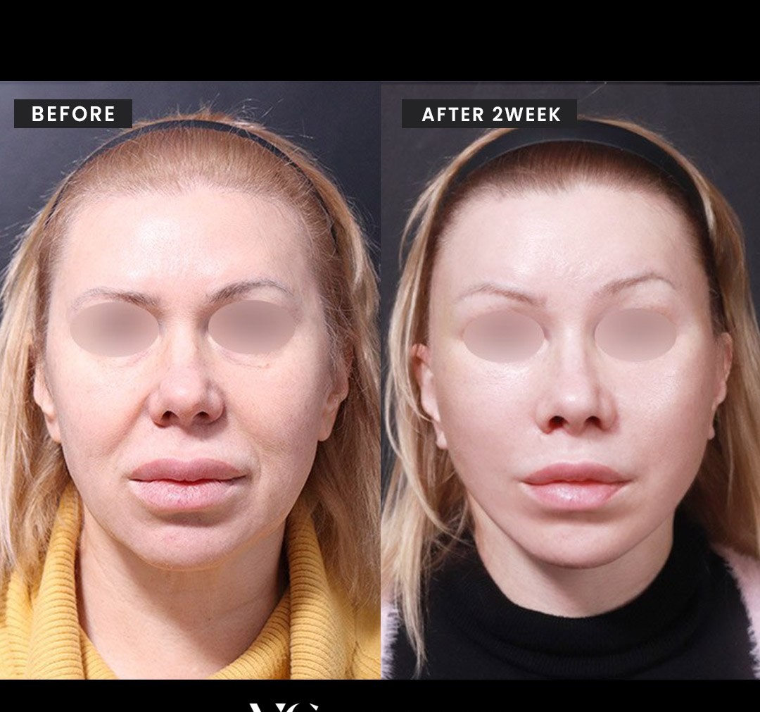 Before and after result by Dr. Kim Yong Woo