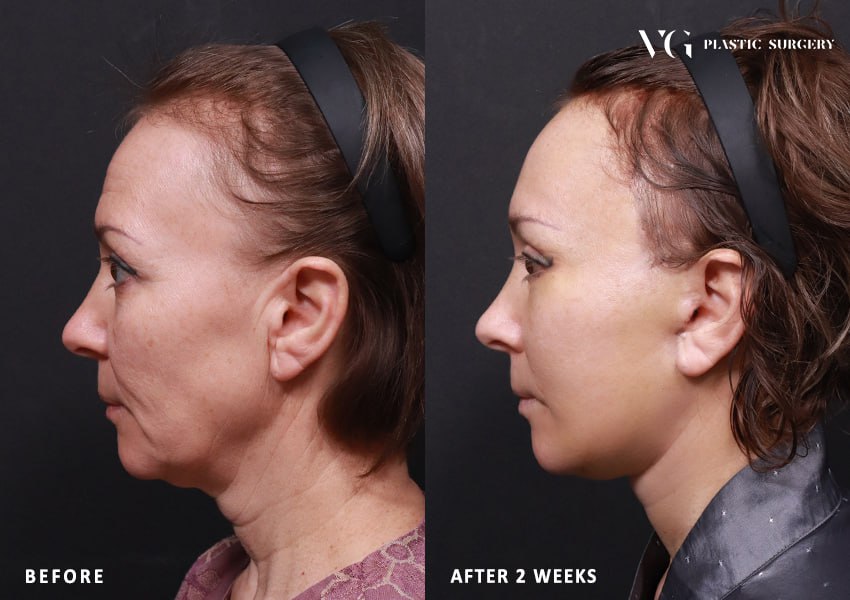 Before and after result by Dr. Kim Yong Woo