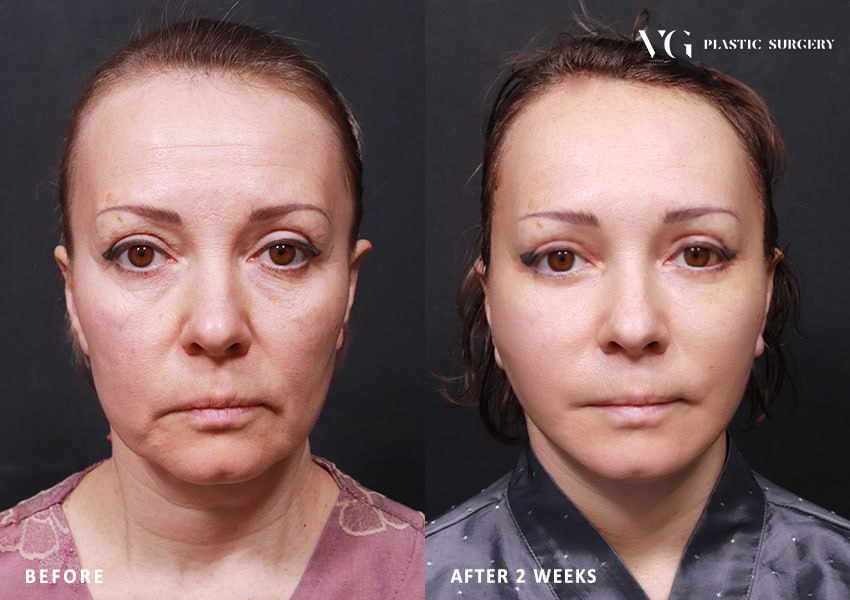 Before and after result by Dr. Kim Yong Woo