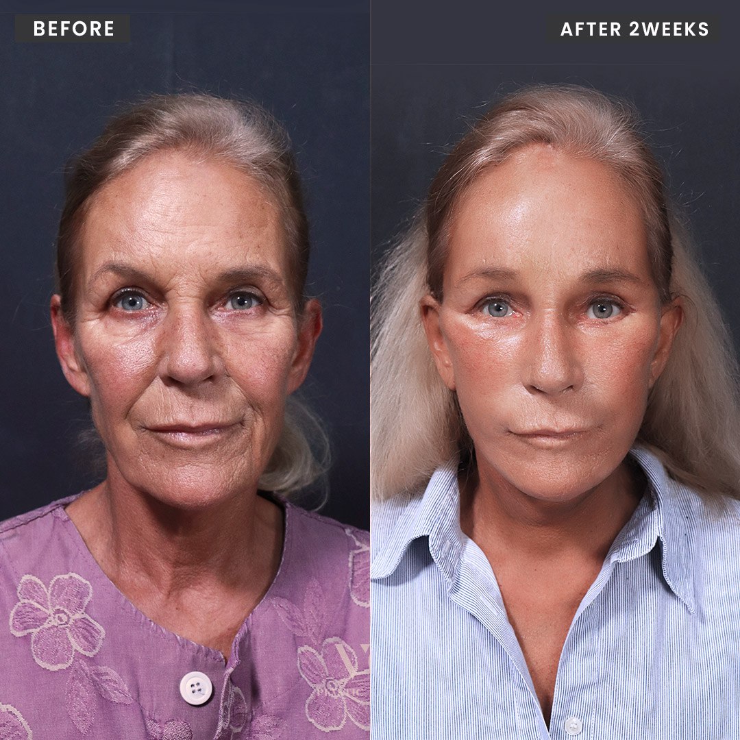 Before and after result by Dr. Kim Yong Woo