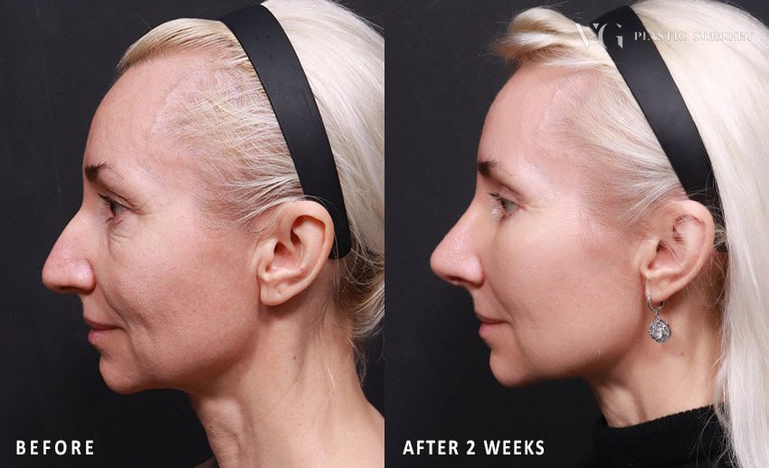 Before and after result by Dr. Kim Yong Woo