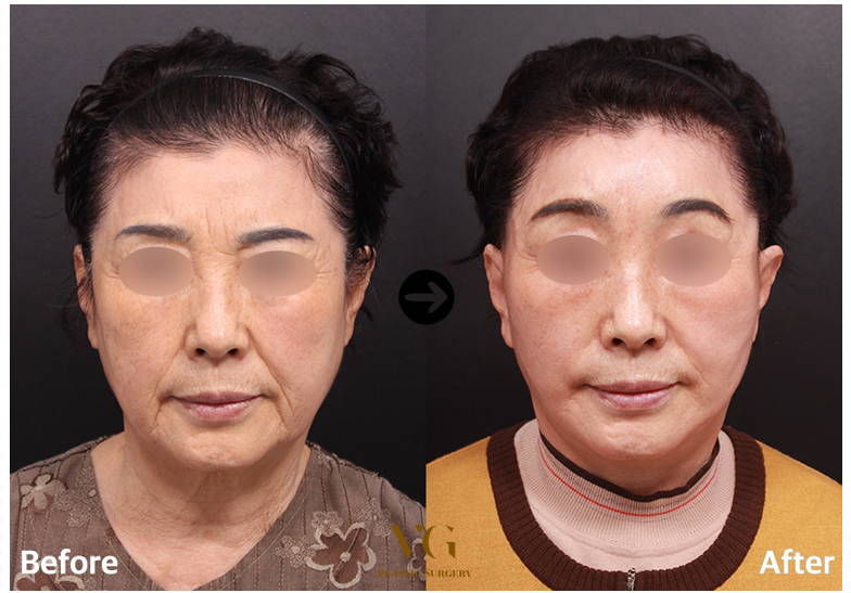 Before and after result by Dr. Kim Yong Woo