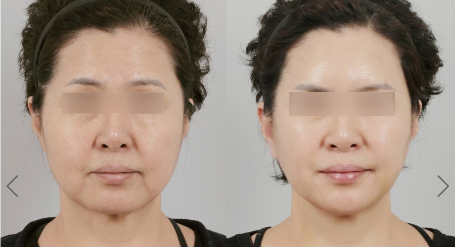 Before and after result by Dr. Park Sang-Hoon