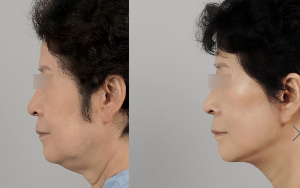 Before and after result by Dr. Park Sang-Hoon