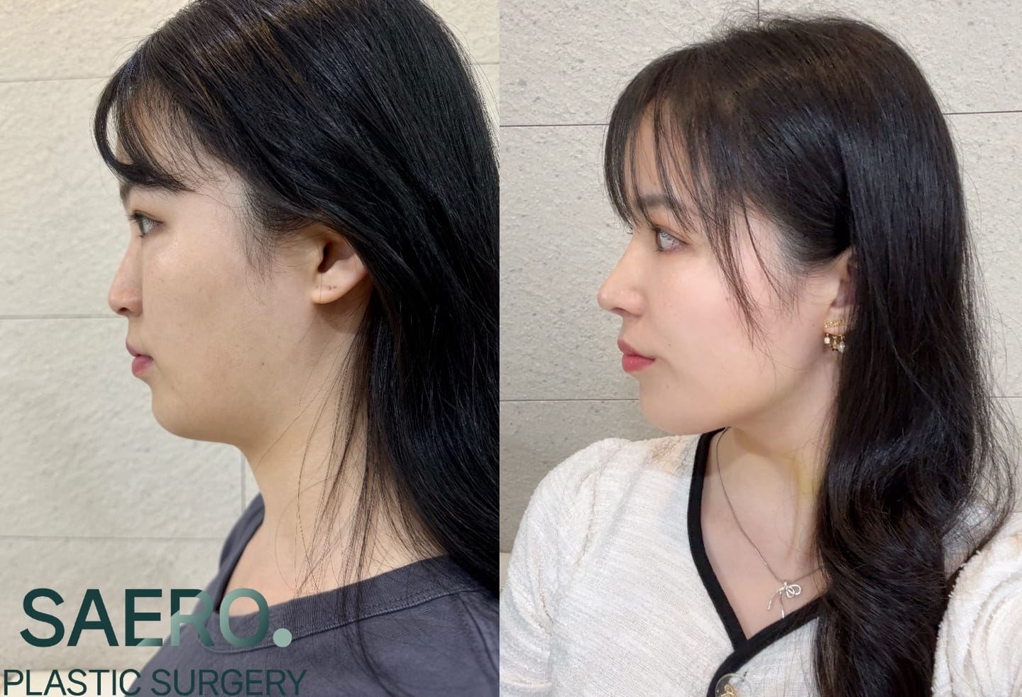 Before and after result by Dr. Park Young Kyu