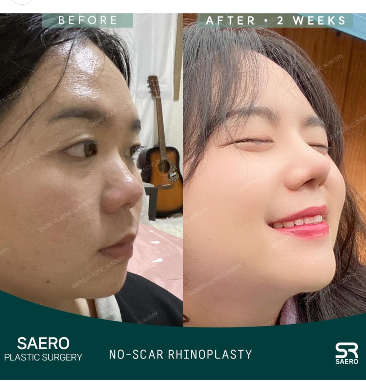 Before and after result by Dr. Park Young Kyu