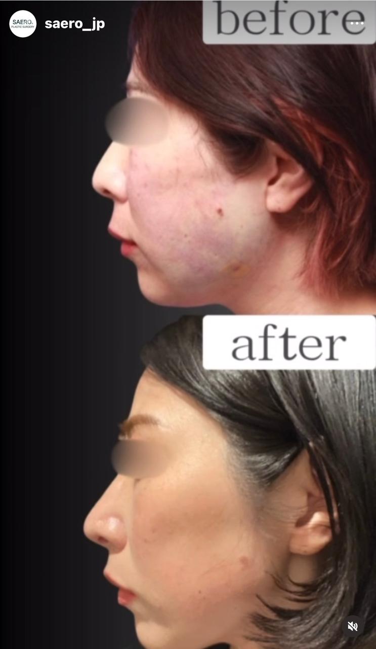 Before and after result by Dr. Park Young Kyu