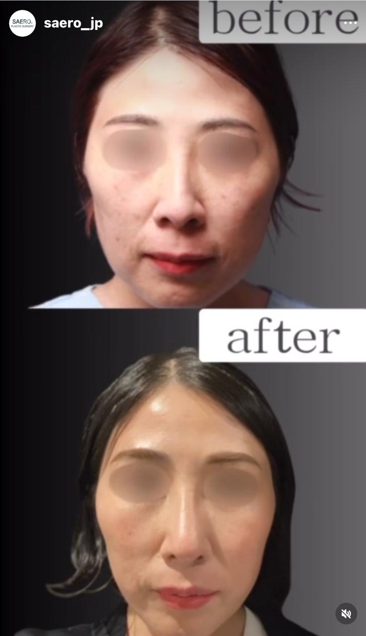 Before and after result by Dr. Park Young Kyu