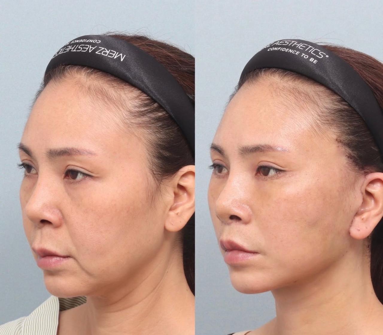 Before and after result by Dr. Park Young Kyu