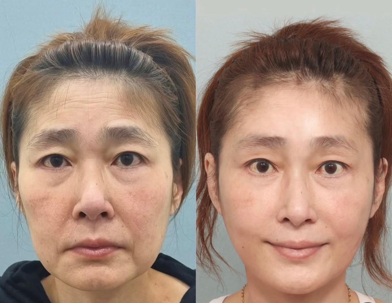Before and after result by Dr. Park Young Kyu